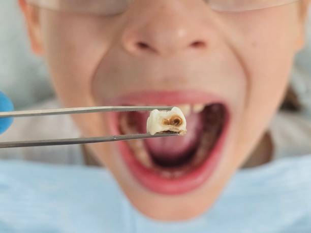 Best Emergency Treatment for Dental Infections or Abscesses in Fetters Hot Springs Agua Liente, CA